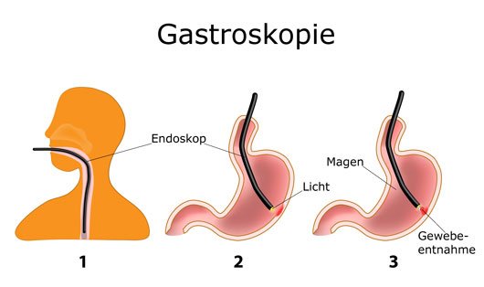 Gastroskopie 1150 Wien kleine Kassen: BVA KFA SVA VAVB und Privat