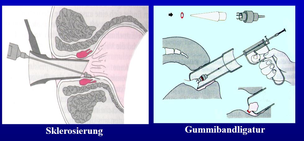 Hämorrhoiden - Gummibandligatur und Sklerosierung