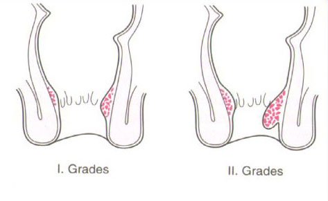 Hämorrhoiden 1ter und 2ter Grad - Behandlung Dr. Peter Hanusch 1150 Wien KFA BVA SVA VAVB und Privat