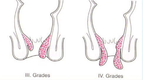 Hämorrhoiden 3ter und 4ter Grad - Behandlung Dr. Peter Hanusch 1150 Wien KFA BVA SVA VAVB und Privat