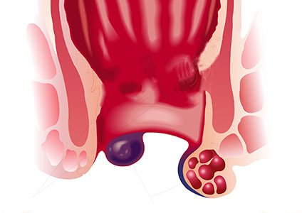 Blutet perianalthrombose Forum für